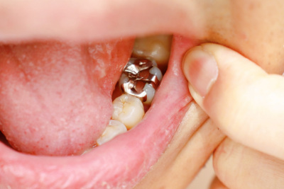 審美歯科のご相談